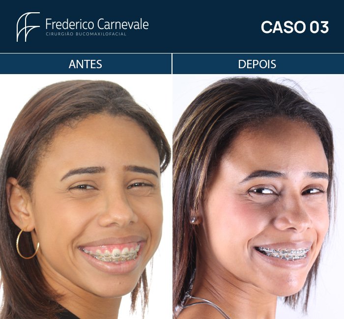 CASO 03 - 01